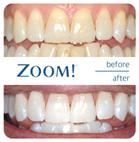 ZOOM!® Teeth Whitening | Porcelain Veneers | Composite Veneers | Dayton